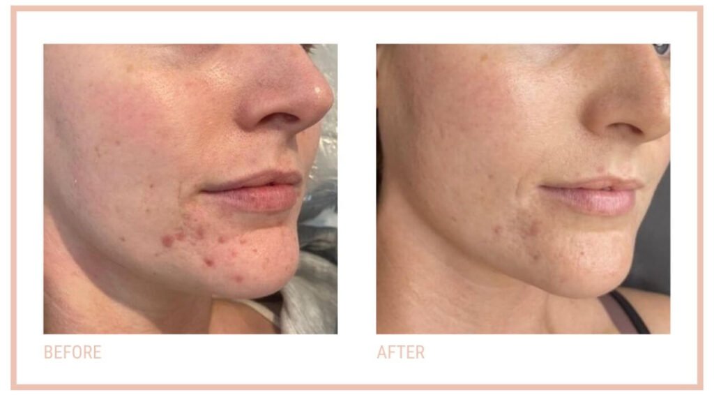 2 Photo's showing the reduction in acne following a CACI facial