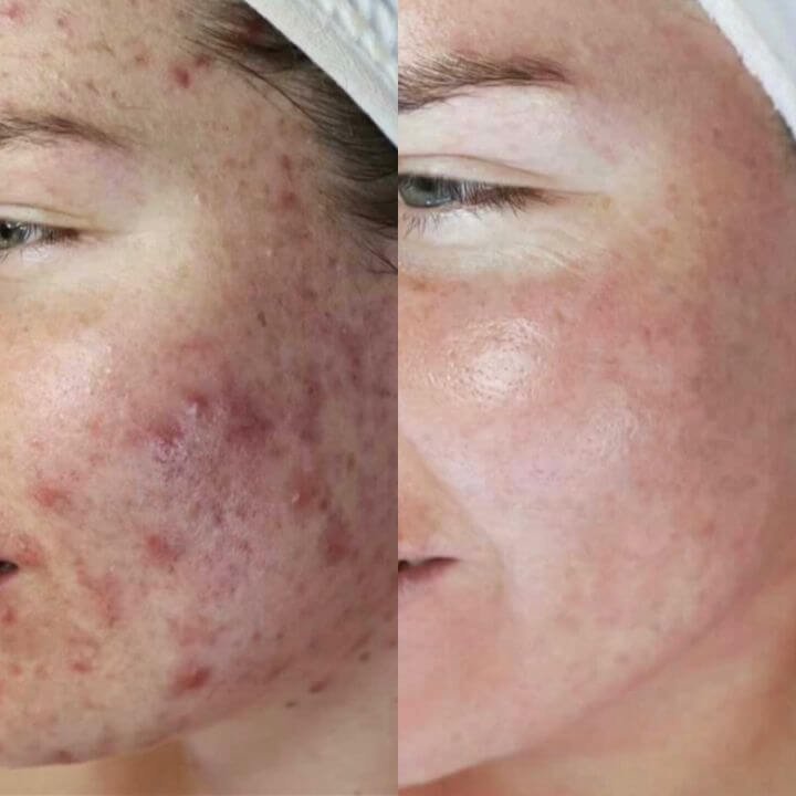 side by side before and after photo of girl with much improved acne following Dermalux LED treatment