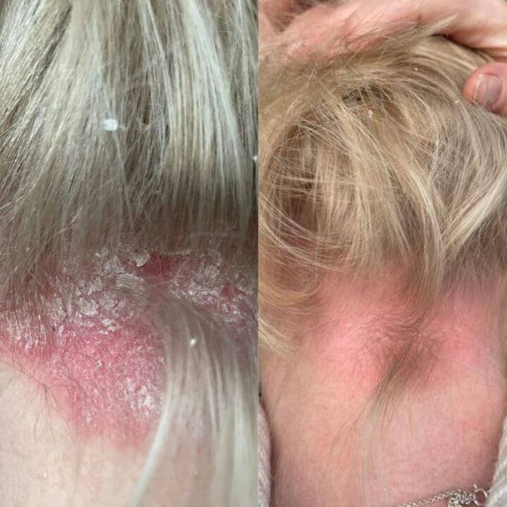 side by side before and after photo showing improvement in psoriasis following Dermalux LED treatment