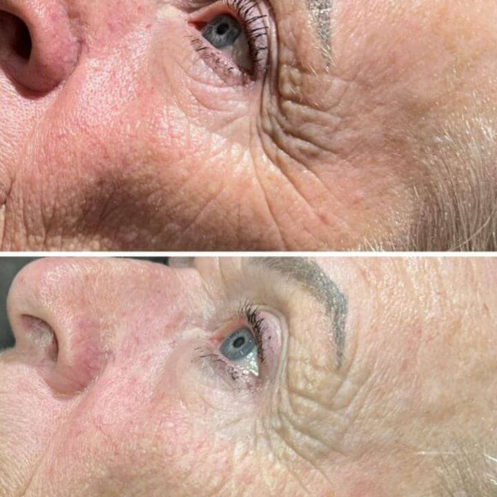 side by side before and after photo of lady showing improvement in facial skin following Dermalux LED treatment