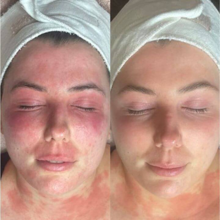 side by side before and after photo of woman showing improvements to her skin following Dermalux LED treatment for Rosacea